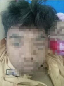 Korban kasus Bullying di SMPN 4 Banyuwangi