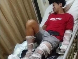 Seorang Pria Banyuwangi Terluka Parah Akibat Petasan yang Dirakitnya Meledak (foto: baliexpress)
