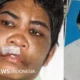 Kondisi Terbaru Korban Penyiksaan Taufik Hidayat, Jalani Operasi Bibir di Bandung