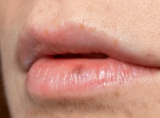 Penyebab Jerawat di Area Bibir Mulut dan Cara Mengatasinya